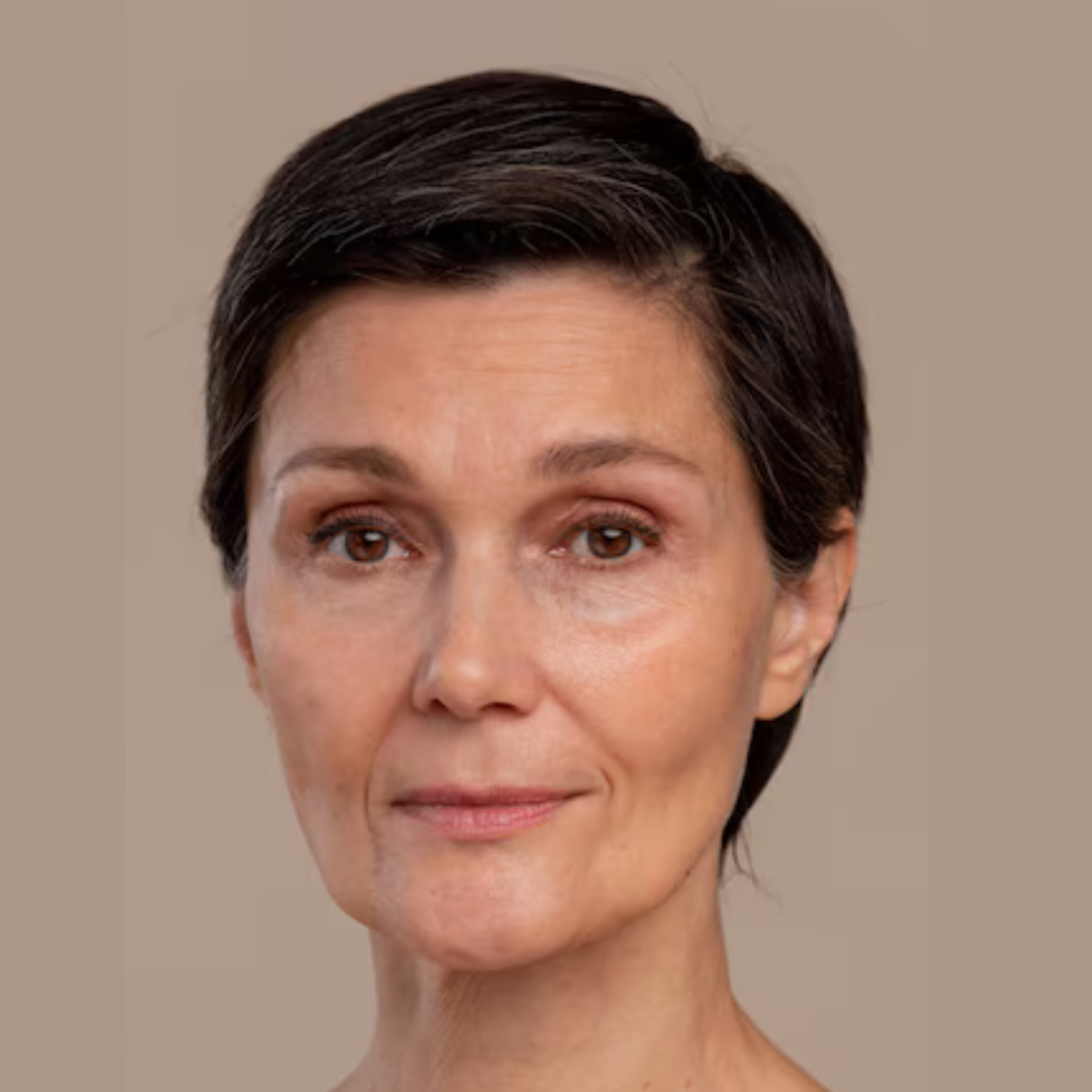 Before Anti Wrinkle Treatment