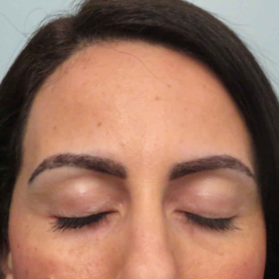 After Eyebrow Transplant