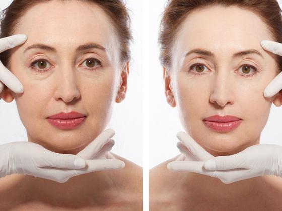 Skin Rejuvenation in Delhi