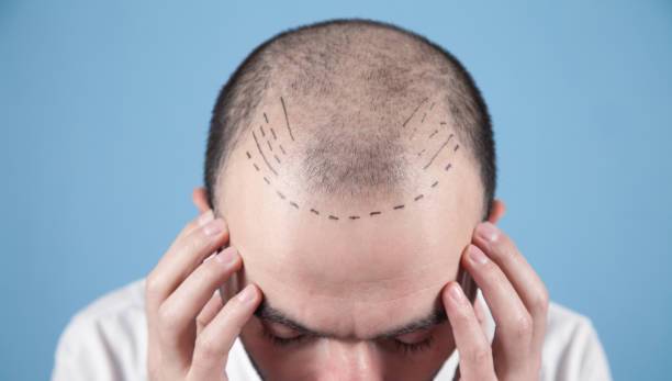 Hairline Transplant Delhi