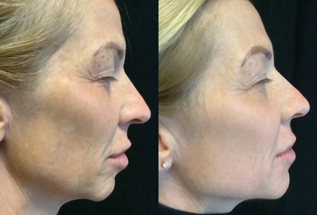 Laser Resurfacing Delhi