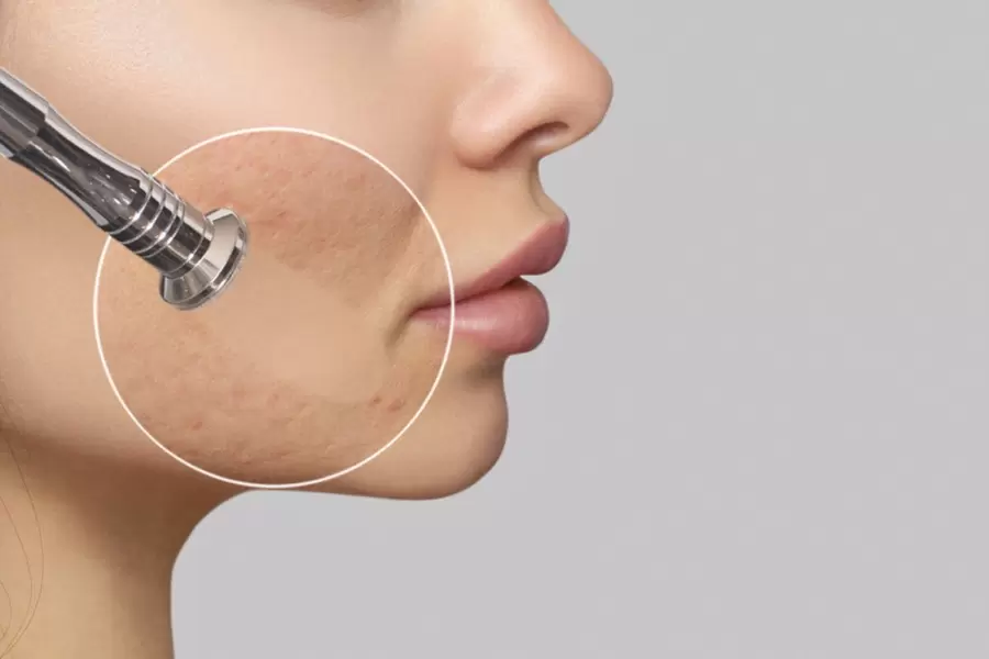 Skin Polishing Process